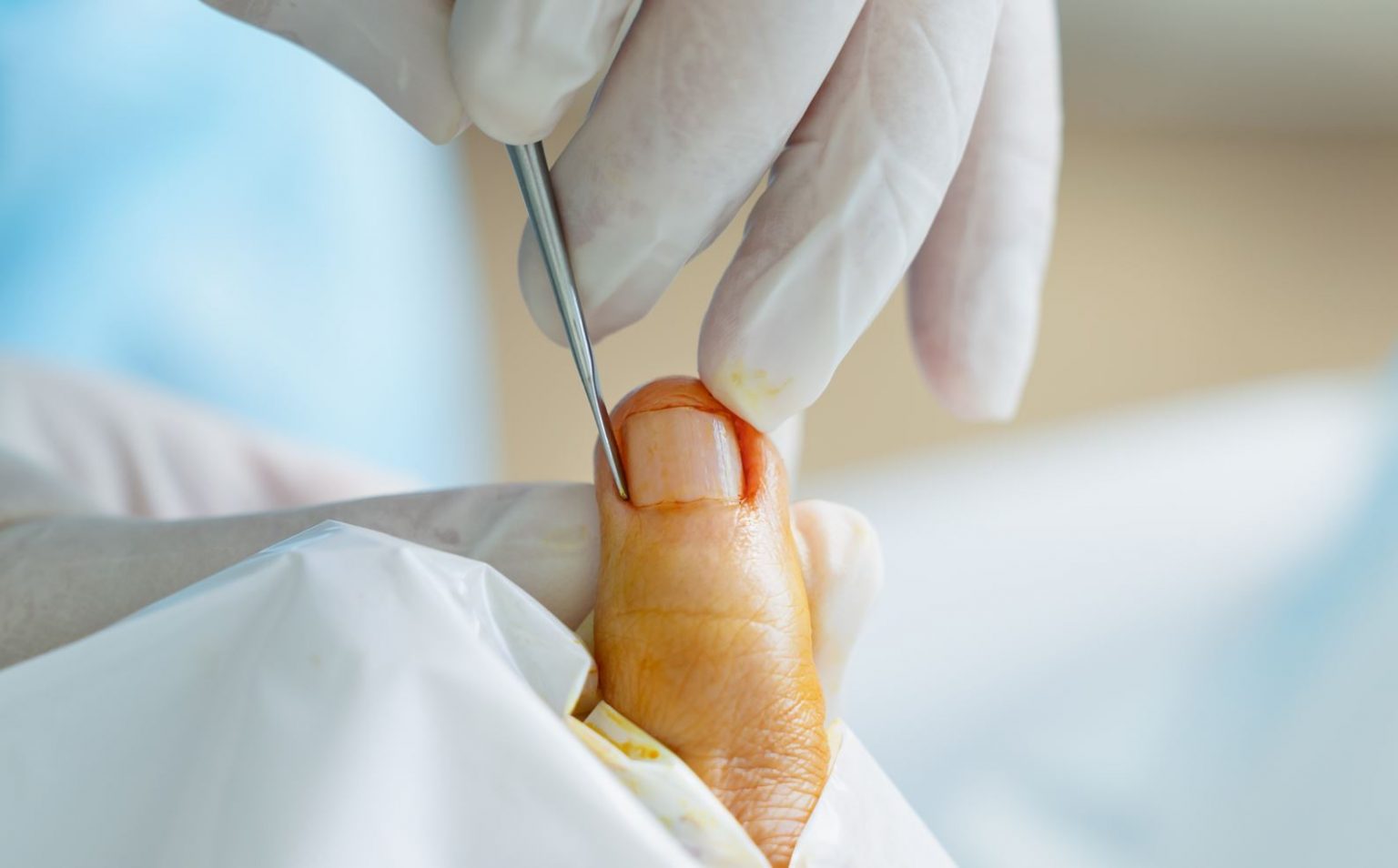 ingrown-toenails-straits-podiatry