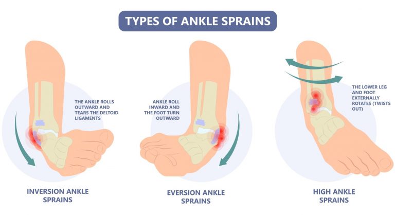 Acute Ankle Sprain Causes And Management Straits Podiatry