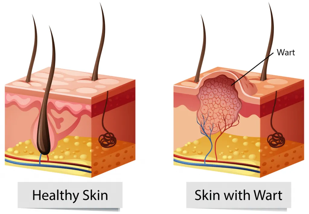 illustration of wart anatomy skin infection