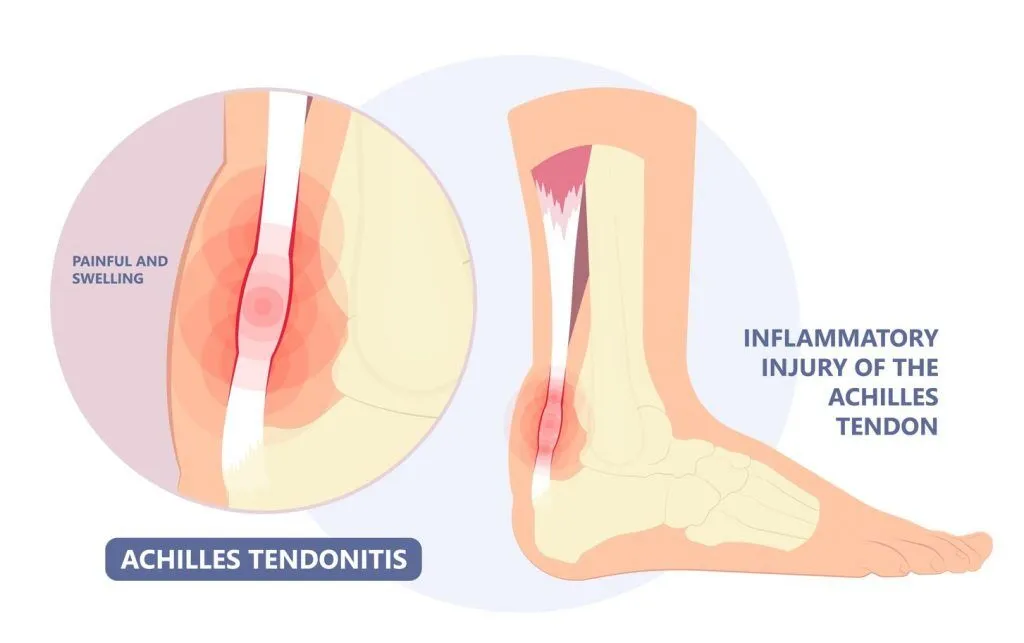 illustration explaining Achilles Tendonitis