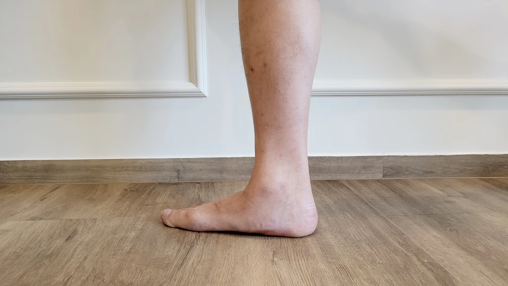Side view of a person standing barefoot showing a collapsed medial arch, characteristic of flat feet
