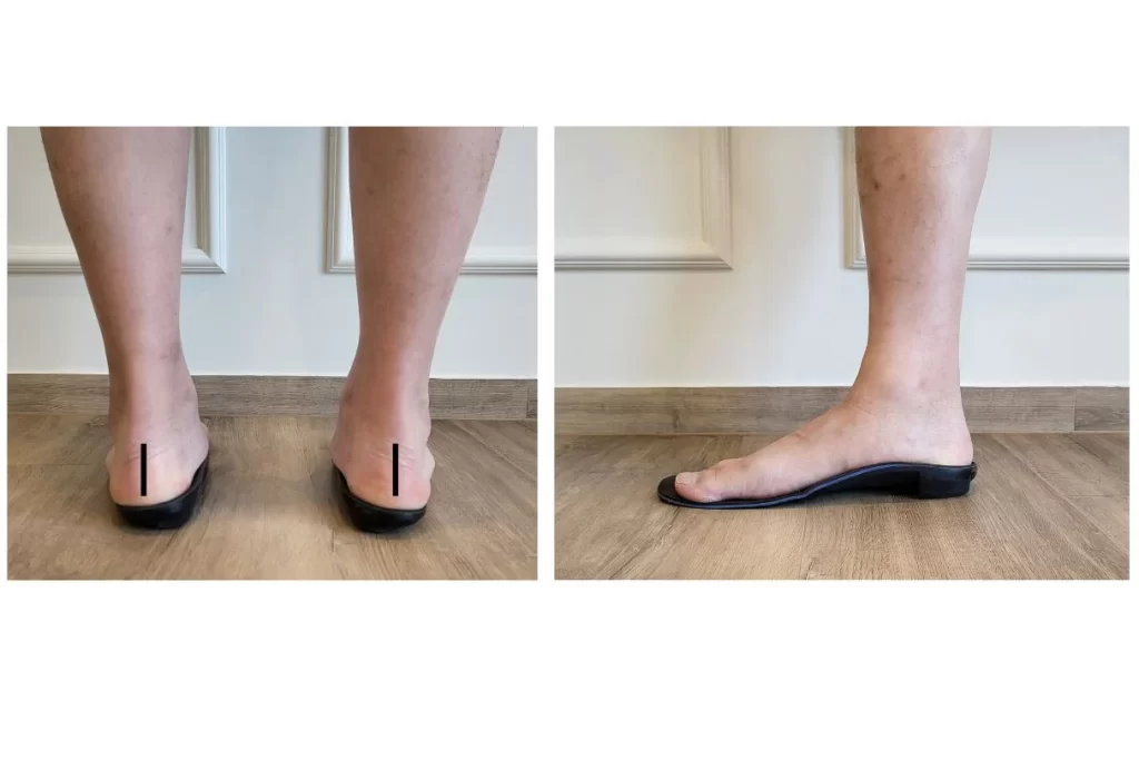 flat feet treatment using custom insoles