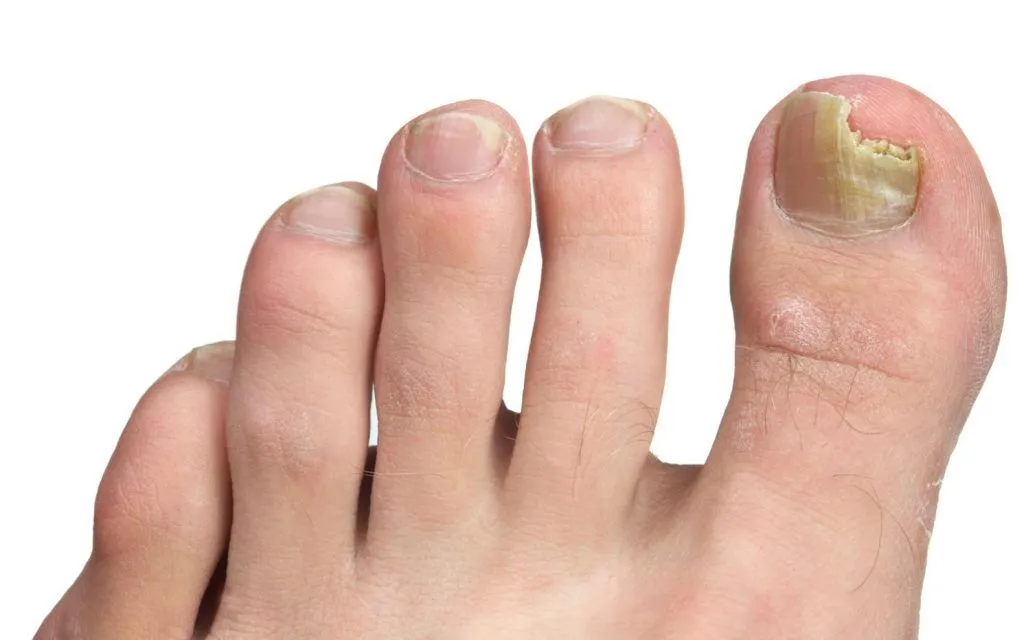 fungal nail infection of the big toe