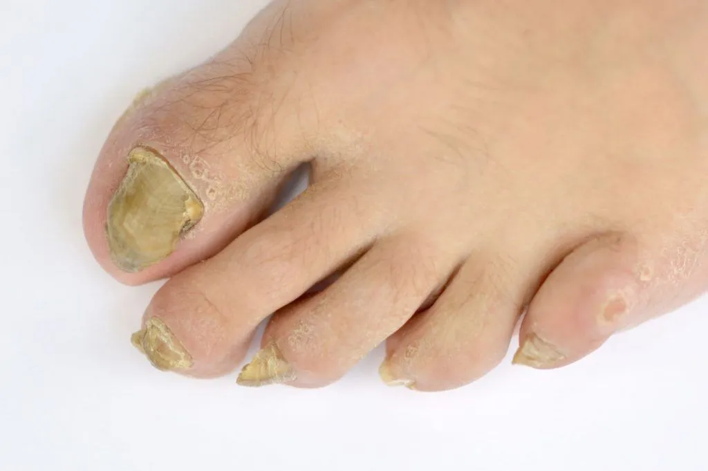 multiple toenails infected by fungus