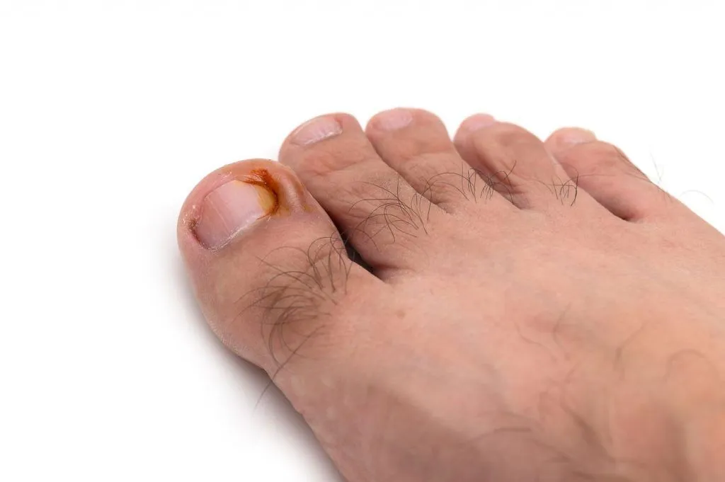 infected ingrown toenail with redness and swelling