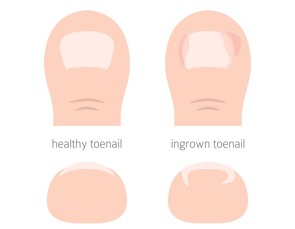anatomy showing the development of ingrown toenails