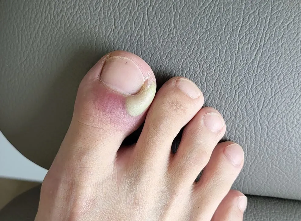 Infected paronychia of the right big toe caused by ingrown toenail and requiring nail surgery treatment