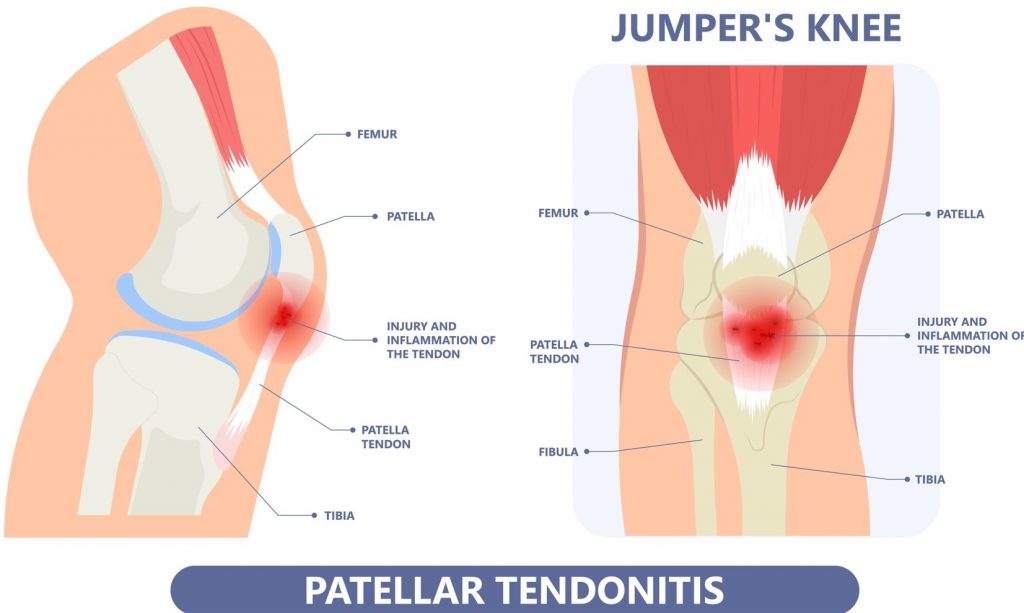 illustration explaining Patellar Tendonitis which is jumper's knee