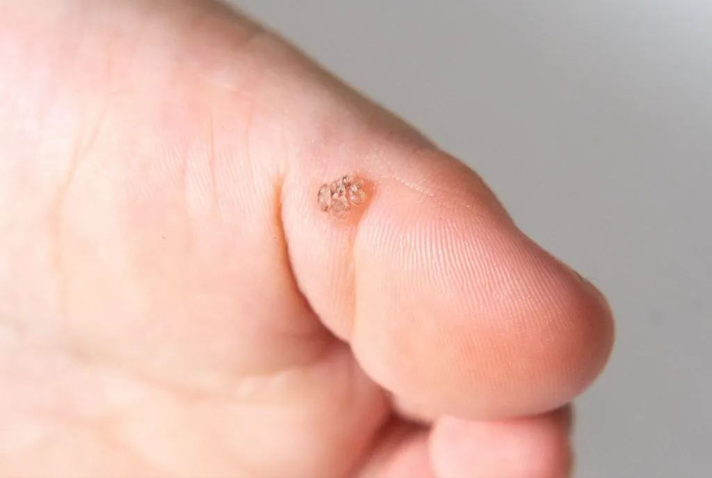 patient with plantar wart