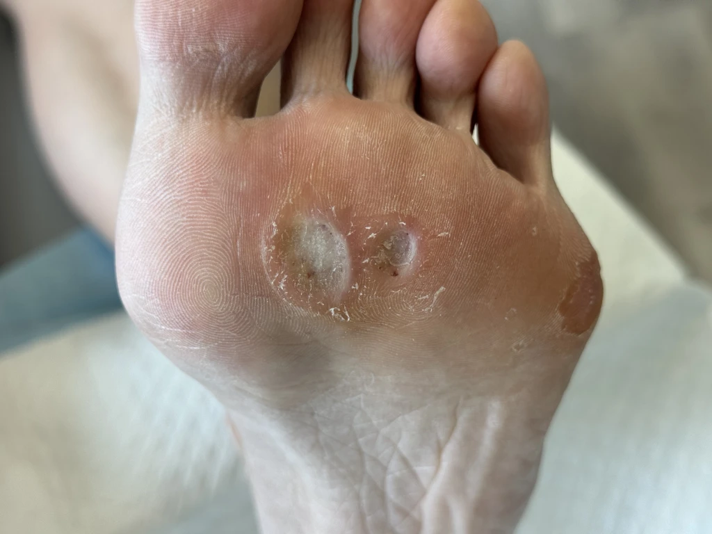 Podiatrist assessing the foot and lower limb to identify factors contributing to Plantar Wart