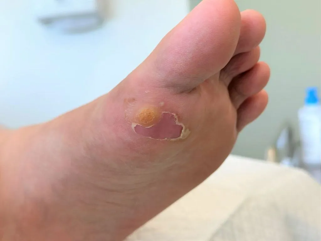 patient with plantar wart on sole of foot singapore