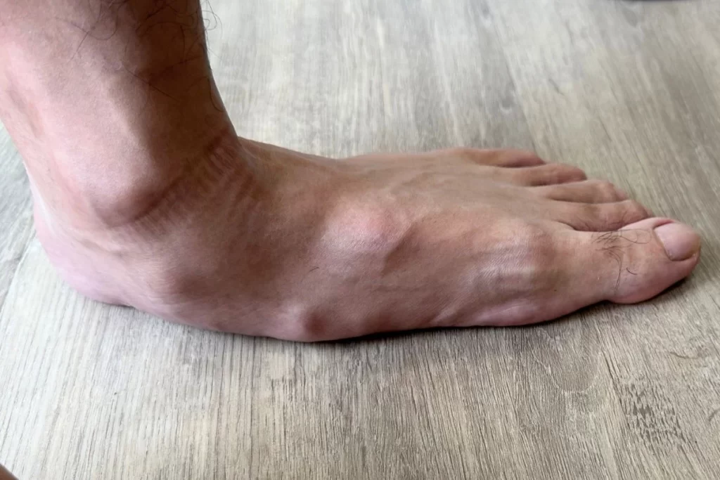 Severe flat feet