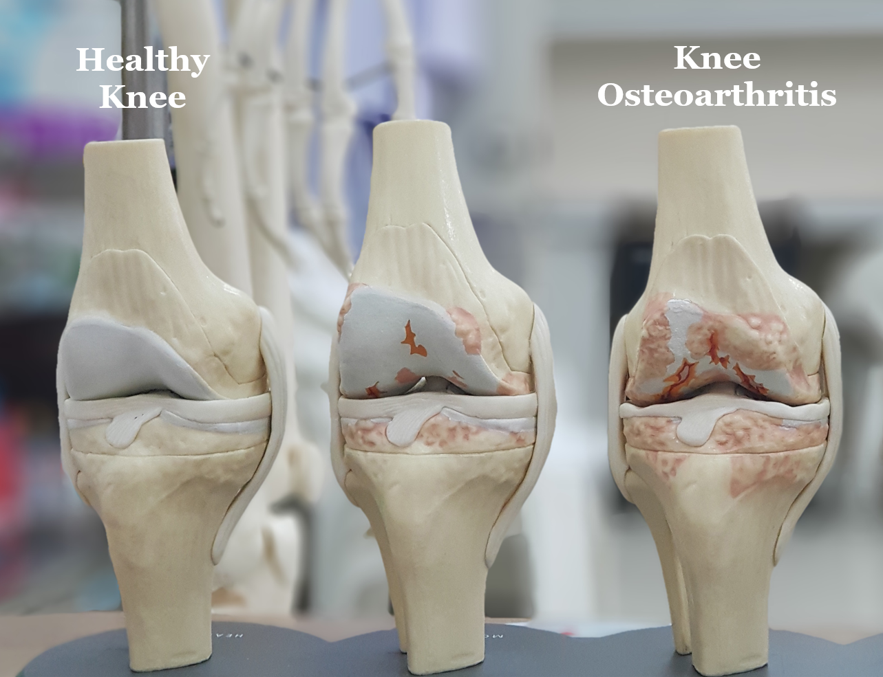 Knee Osteoarthritis | Symptoms & Treatment - Straits Podiatry