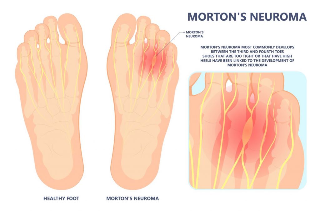 What is Neuroma? What is Morton's Neuroma? Straits Podiatry