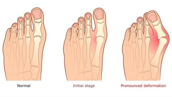 A medical illustration showing three stages of a bunion at the big toe joint, labelled normal, initial stage, and pronounced deformity, with the enlarging joint highlighted in red.