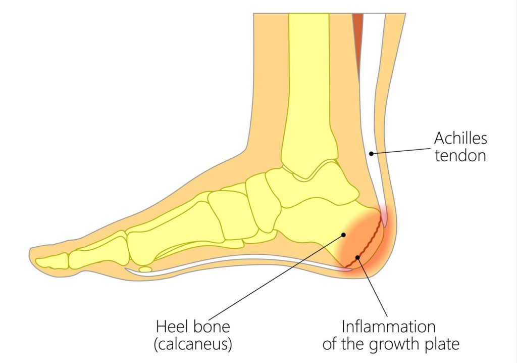 What is Sever's disease? Why is my child's heel painful? Straits Podiatry