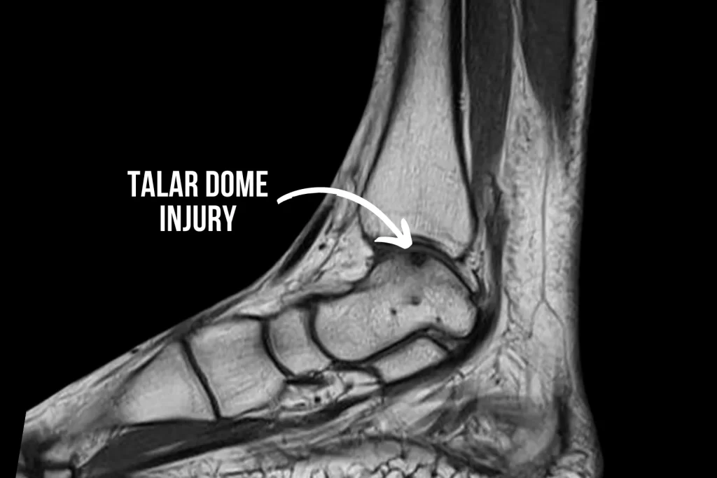 patient with talar dome injury illustration xray