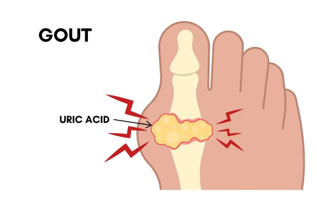 Gout on the big toe joint