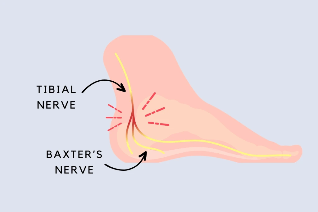 Illustration of the inner side of the foot showing the tibial nerve branching near the heel into Baxter's nerve, with red marks highlighting the site where Baxter's nerve becomes compressed.