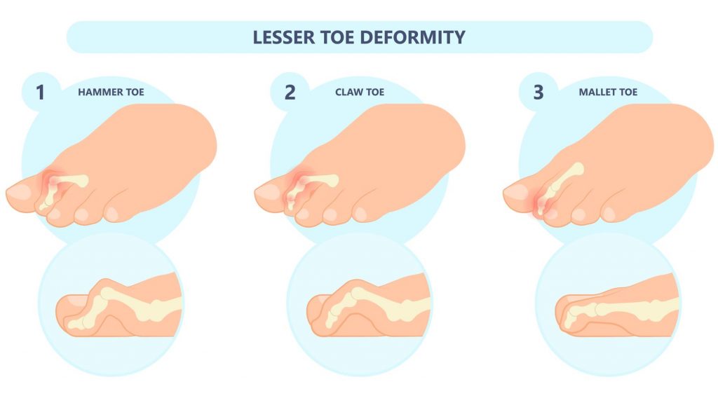 illustration of clawed and hammer toes