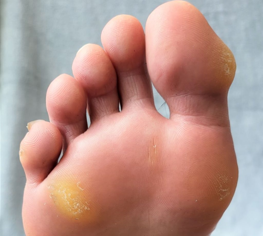 Painful callus bottom of foot online