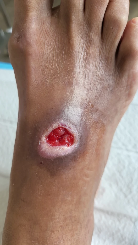 Illustration showing the affected area in Diabetic Foot Ulcer