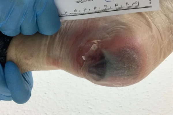 足科医师评估足部与下肢,以找出引发糖尿病足溃疡的因素