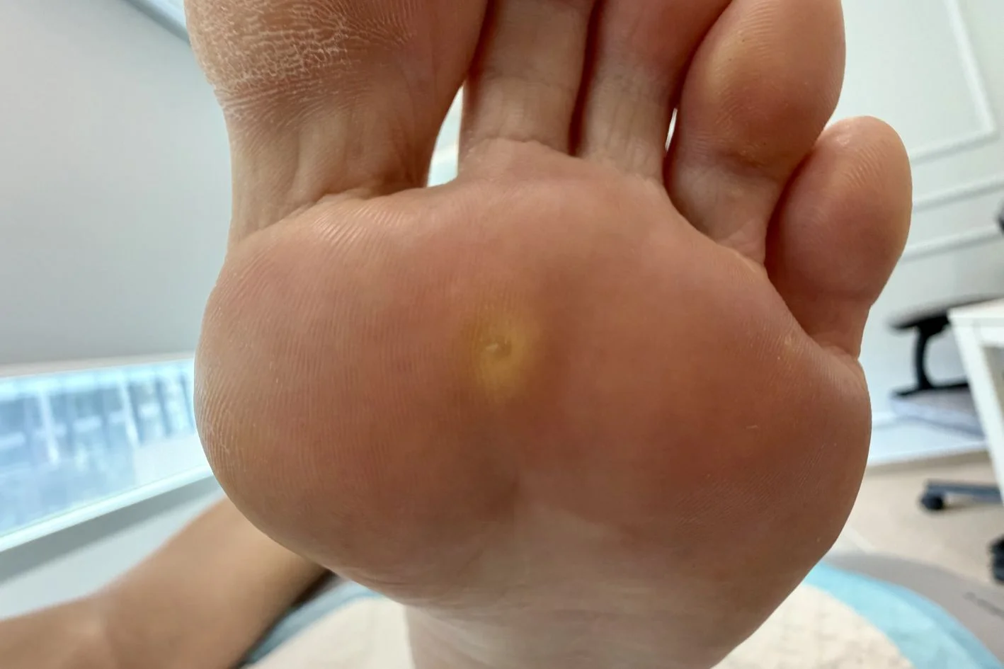 左脚底长了痛脚垫。