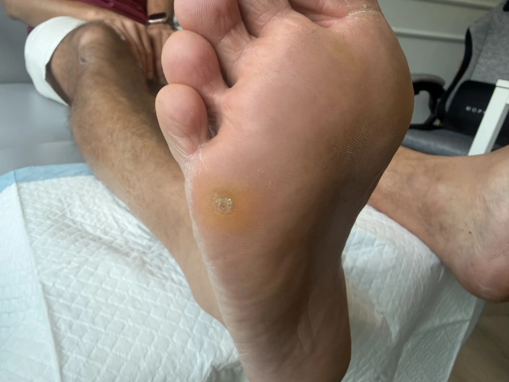 A close-up of the sole of a foot on clinic couch paper showing a small round yellow thickening with a central core typical of corns