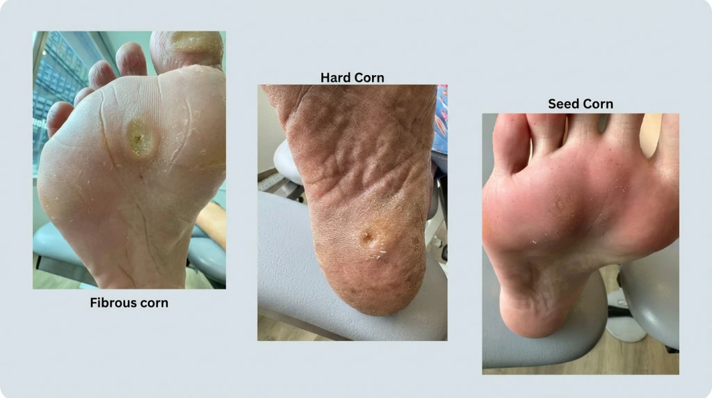 Podiatrist assessing the foot and lower limb to identify factors contributing to Foot Corns