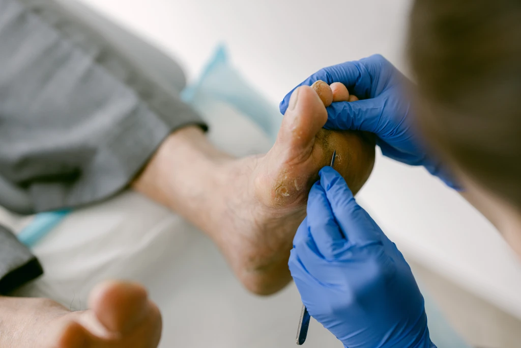 A clinician in blue gloves uses a small scalpel blade to pare hardened skin from the ball of a patient's foot, the standard way corns are debrided