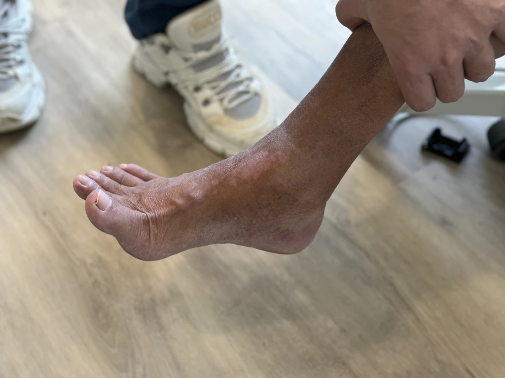 A patient's foot hanging in the dropped, plantarflexed position characteristic of foot drop, with an ankle-foot orthosis nearby