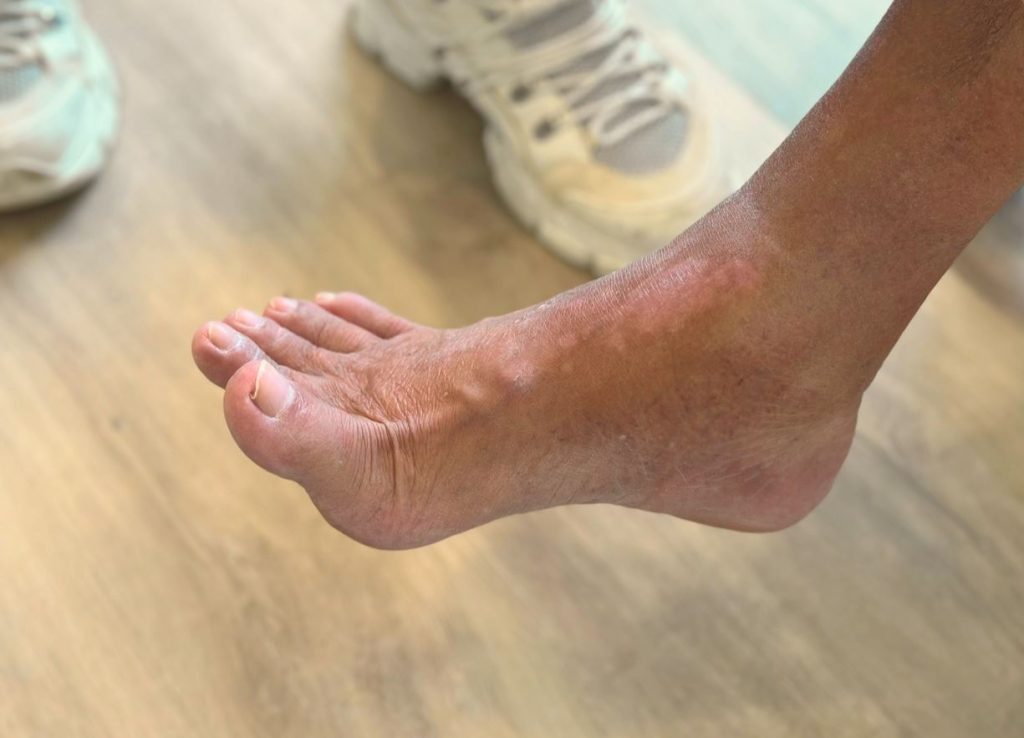 What is foot drop? Signs and symptoms of foot drop. Straits Podiatry Singapore