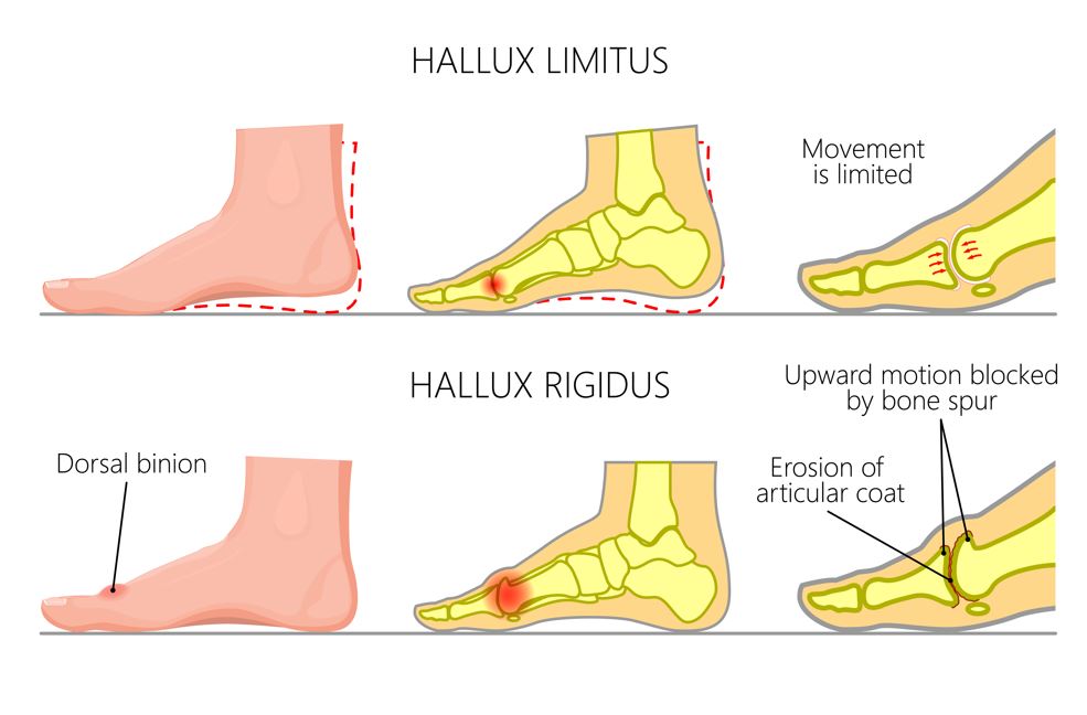 illustration of hallux rigidus explanation