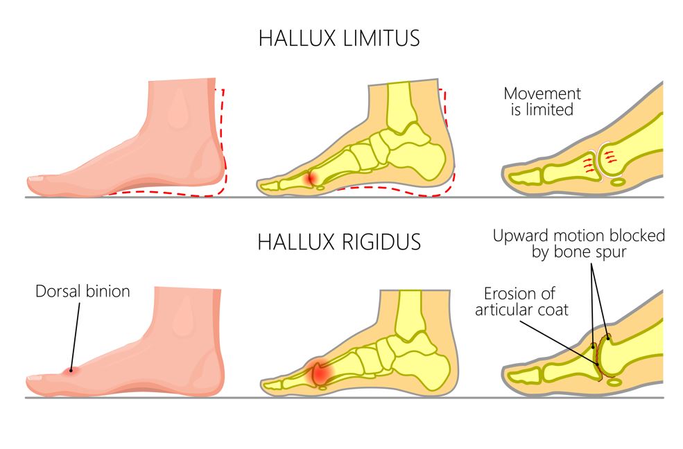 Hallux Rigidus Explained