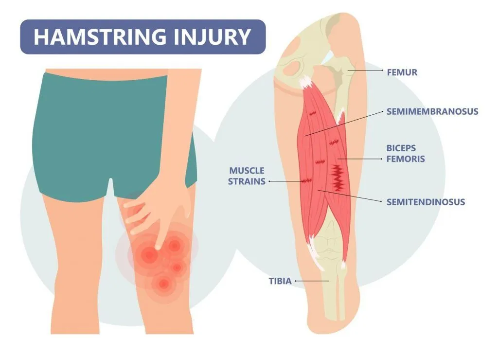 illustration of hamstring injury