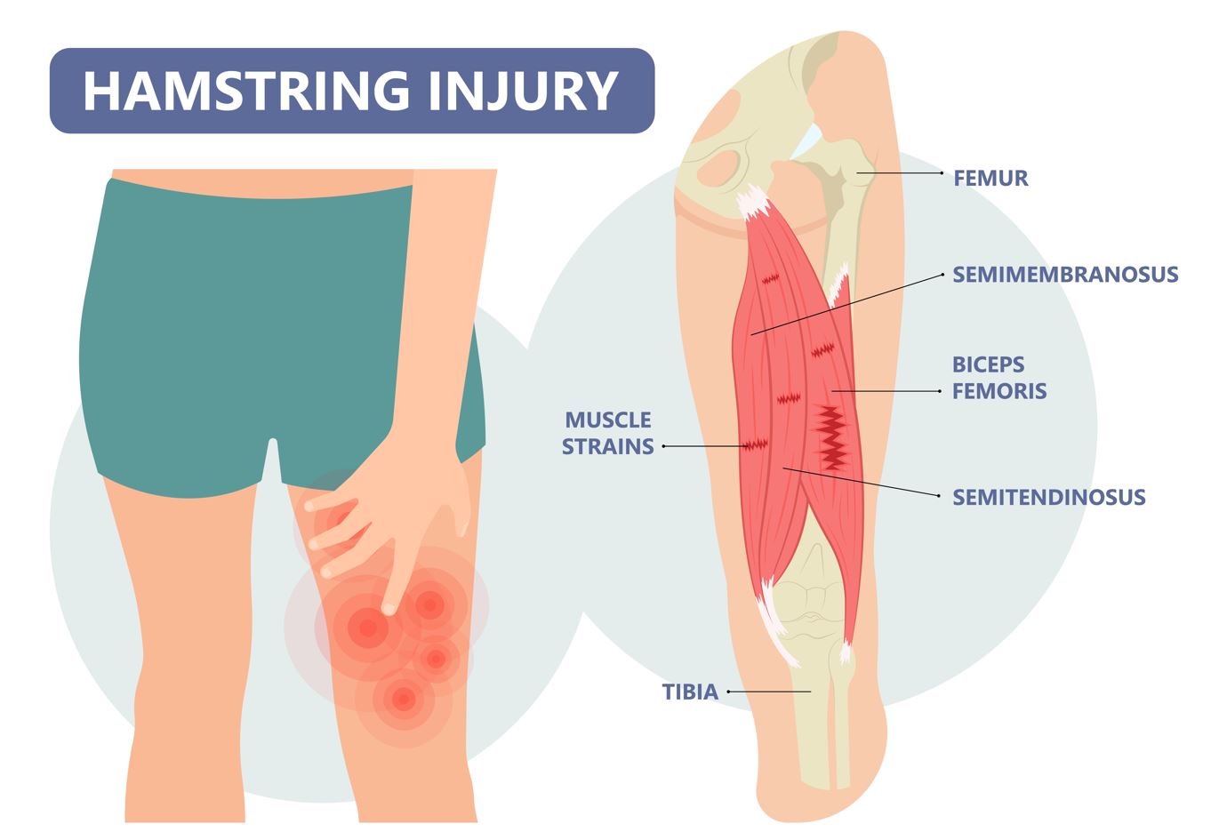 hamstring-strain-straits-podiatry