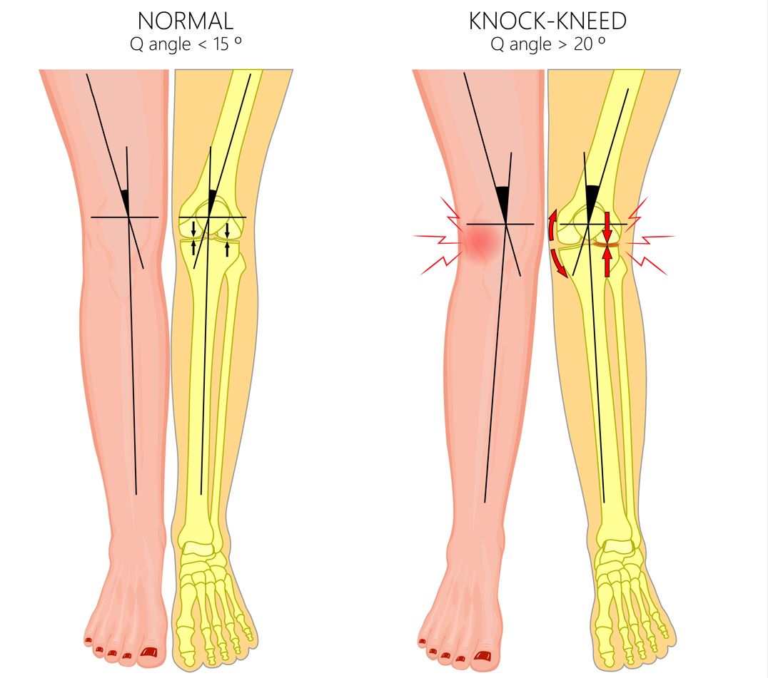 Knock Knees in Children | Causes & Treatment - Straits Podiatry