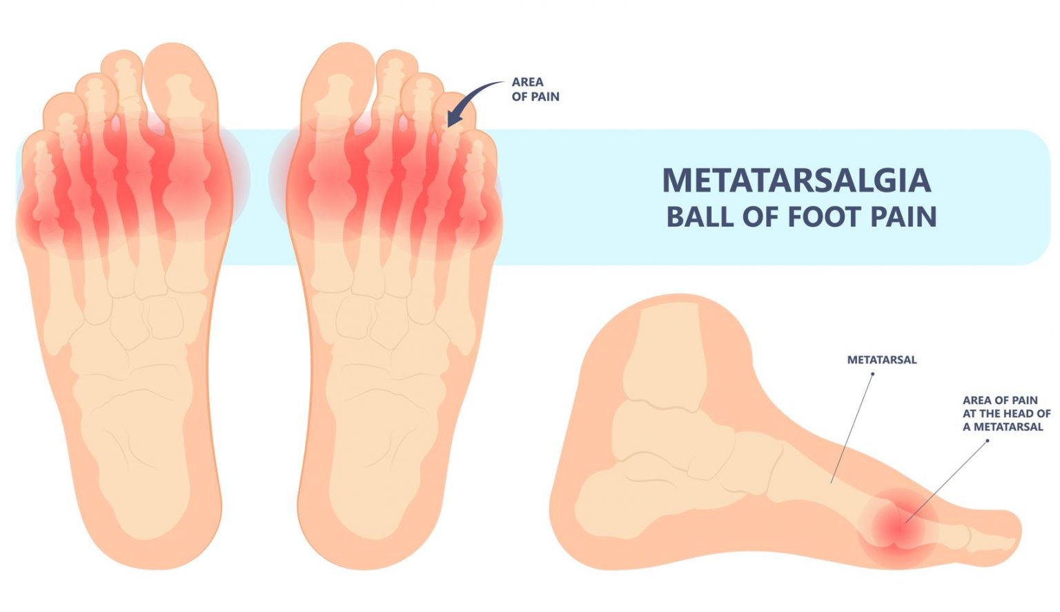 Metatarsalgia | Causes & Management - Straits Podiatry