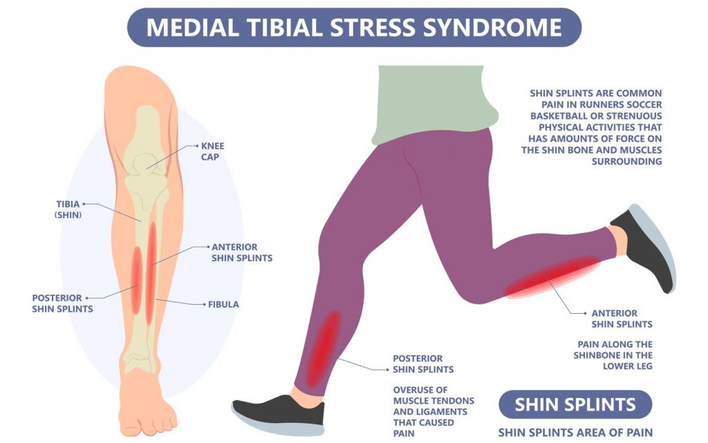 Medial Tibial Stress Syndrome Shin Splints Straits Podiatry