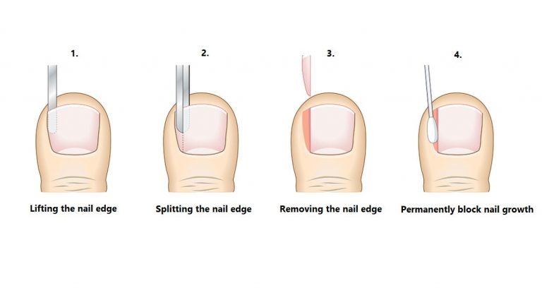 Partial Nail Avulsion (Ingrown Toenail Surgery) - Straits Podiatry