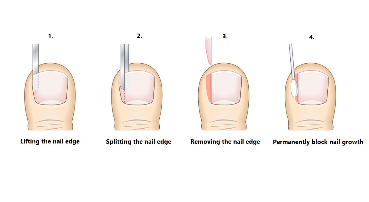 Partial Nail Avulsion Ingrown Toenail Surgery Straits Podiatry