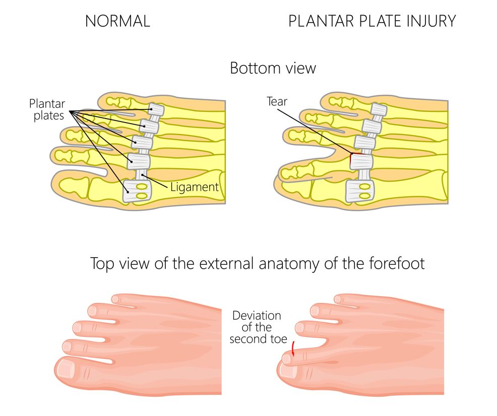 plantar plate condition illustration
