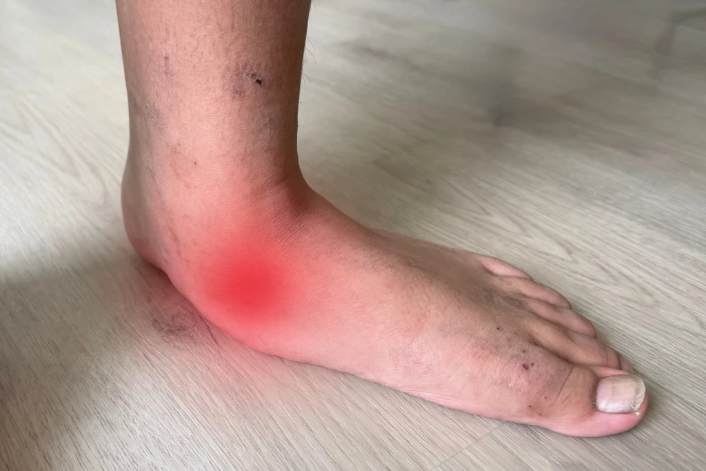 Illustration showing the affected area in Posterior Tibial Tendonitis