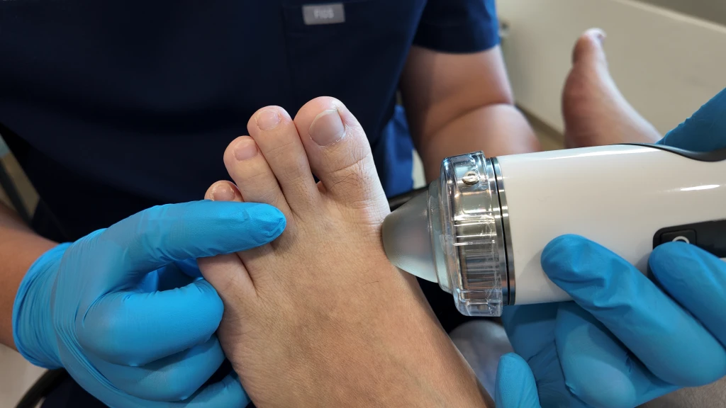 A podiatrist in blue gloves steadies a patient's forefoot while pressing a handheld shockwave applicator against the ball of the foot near the big toe joint, the area affected in sesamoiditis.