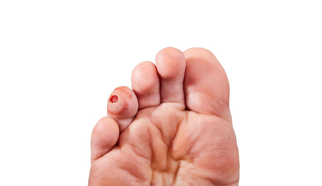 Wart Needling and Curettage at Straits Podiatry