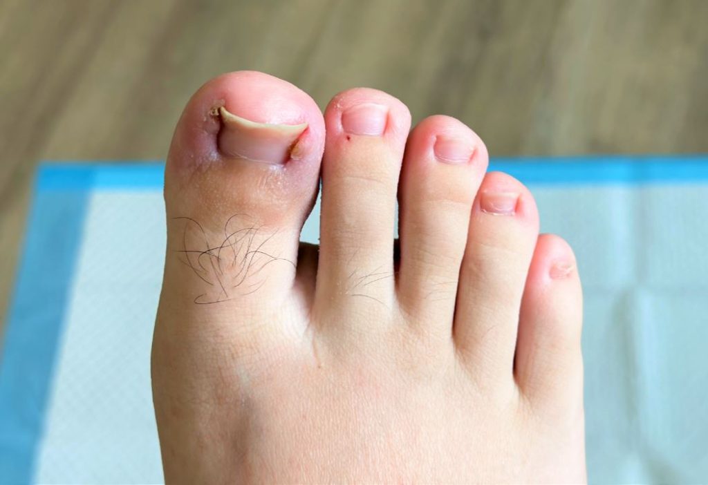 Ingrown toenail treatment in Singapore