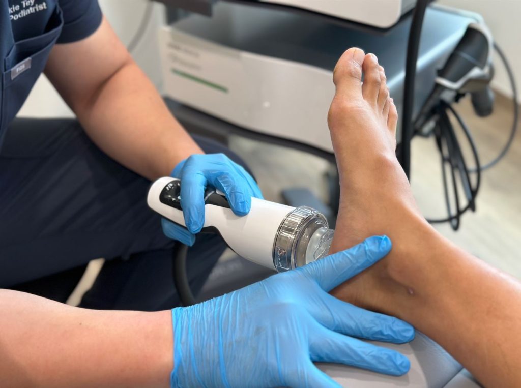 Shockwave therapy in plantar fasciitis treatment. A photo showing podiatrist from Straits Podiatry in Singapore performing shockwave therapy to treat a case of plantar fasciitis.