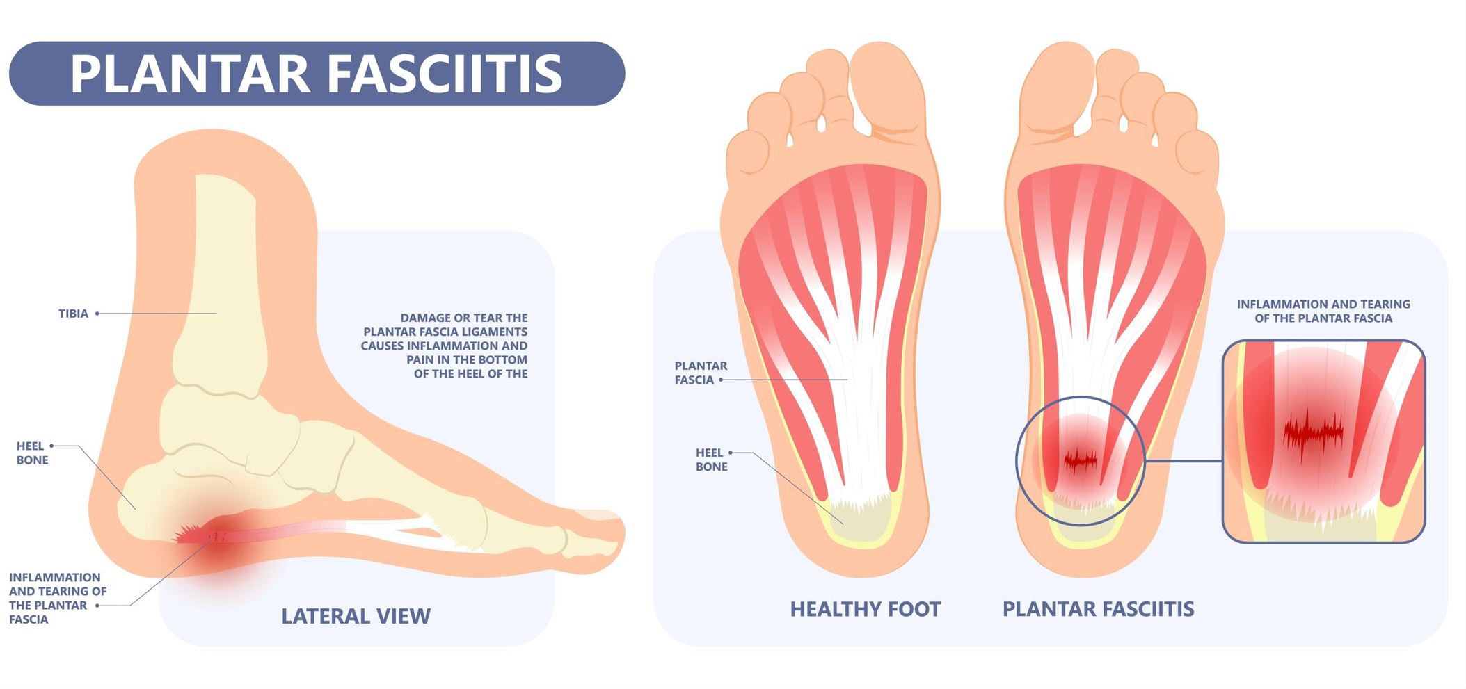 Plantar fasciitis is the main cause of heel  pain in Singapore.