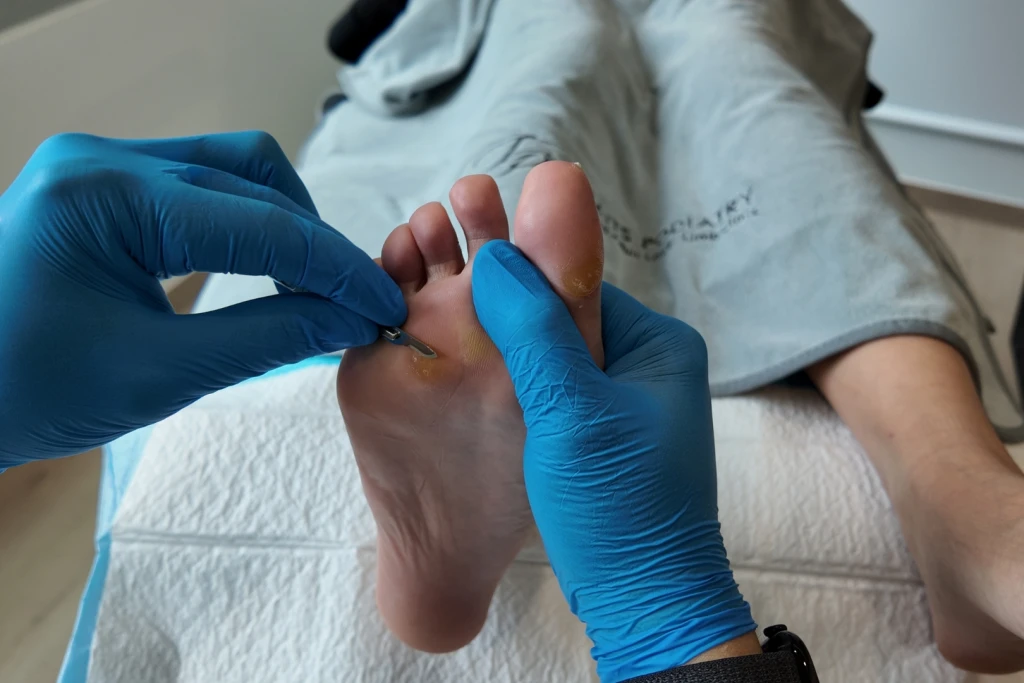 A podiatrist in gloves uses a small scalpel blade to pare thickened yellow skin from the ball of a patient's foot, the debridement that removes a foot corn but not the pressure causing it.